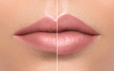 Volumen y Diseño de Labios