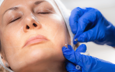 Hilos Bioestimuladores